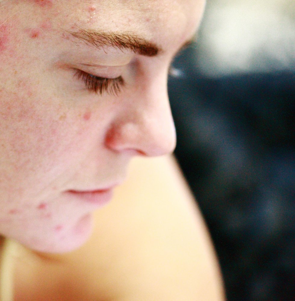 Facing up to acne
